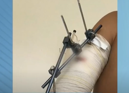 Varginha: suspeito de fugir após atropelar motoboy está preso