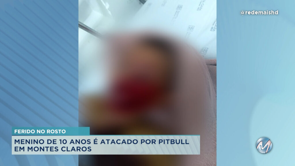 Menino de 10 anos fica gravemente ferido após ser atacado por pitbull