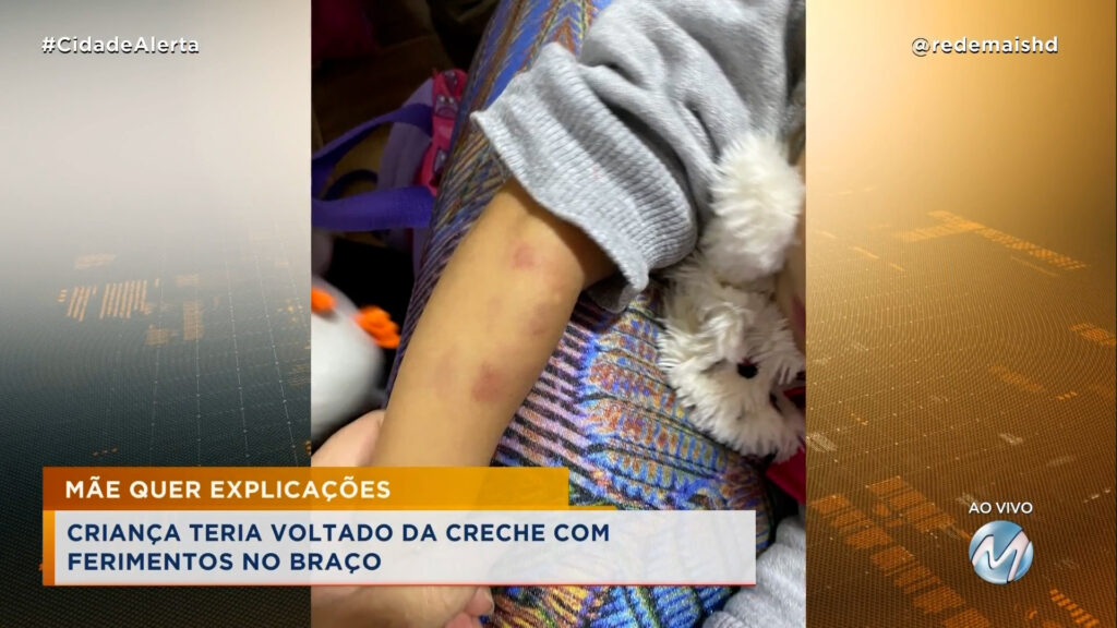 CRIANÇA COM FERIMENTOS: MÃE QUER SABER O QUE ACONTECEU COM A FILHA ENQUANTO ESTAVA NA CRECHE