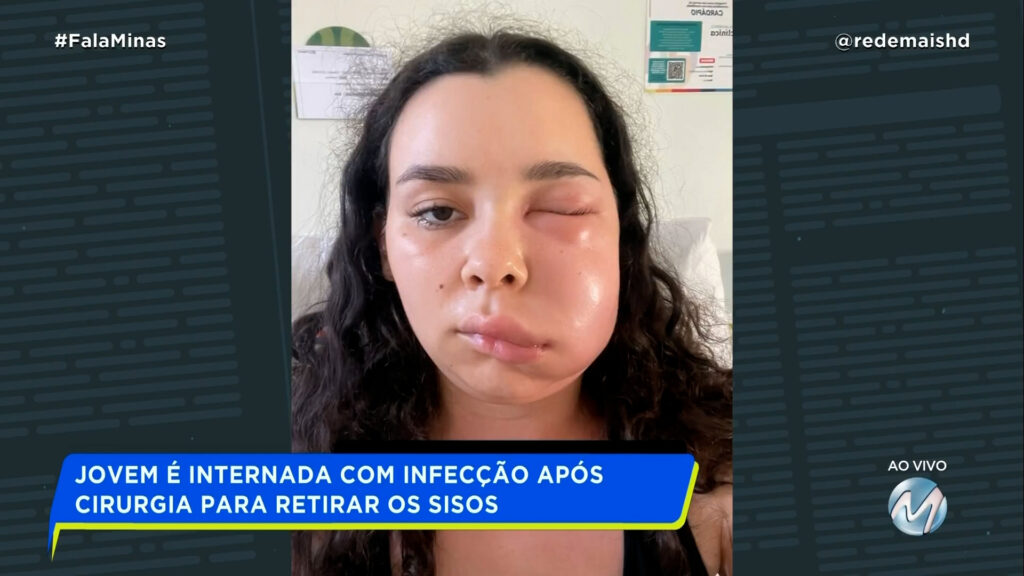 JOVEM É INTERNADA COM INFECÇÃO APÓS CIRURGIA PARA RETIRAR OS SISOS JOVEM É INTERNADA COM INFECÇÃO APÓS CIRURGIA PARA RETIRAR OS SISOS