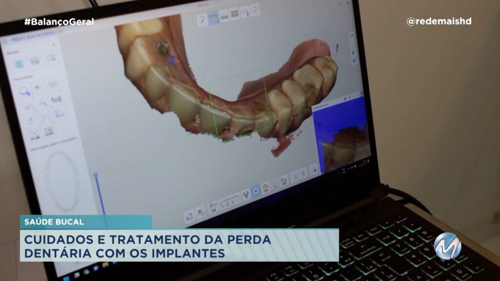 SAÚDE BUCAL: CUIDADOS E TRATAMENTO DA PERDA DENTÁRIA COM OS IMPLANTES