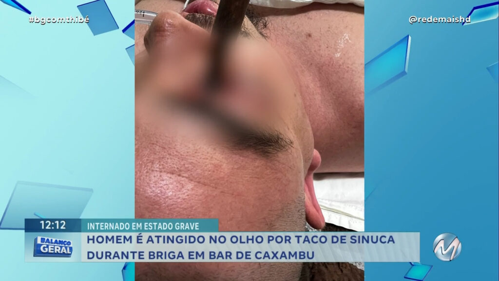 HOMEM É ATINGIDO NO OLHO POR TACO DE SINUCA DURANTE BRIGA EM BAR DE CAXAMBU