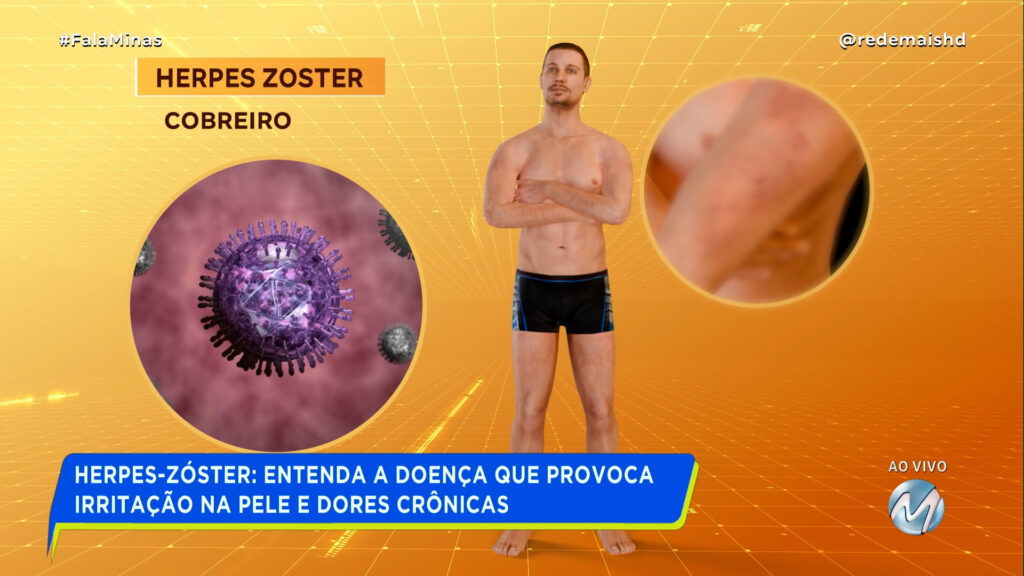 HERPES-ZÓSTER: ENTENDA A DOENÇA QUE PROVOCA IRRITAÇÃO NA PELE E DORES CRÔNICAS