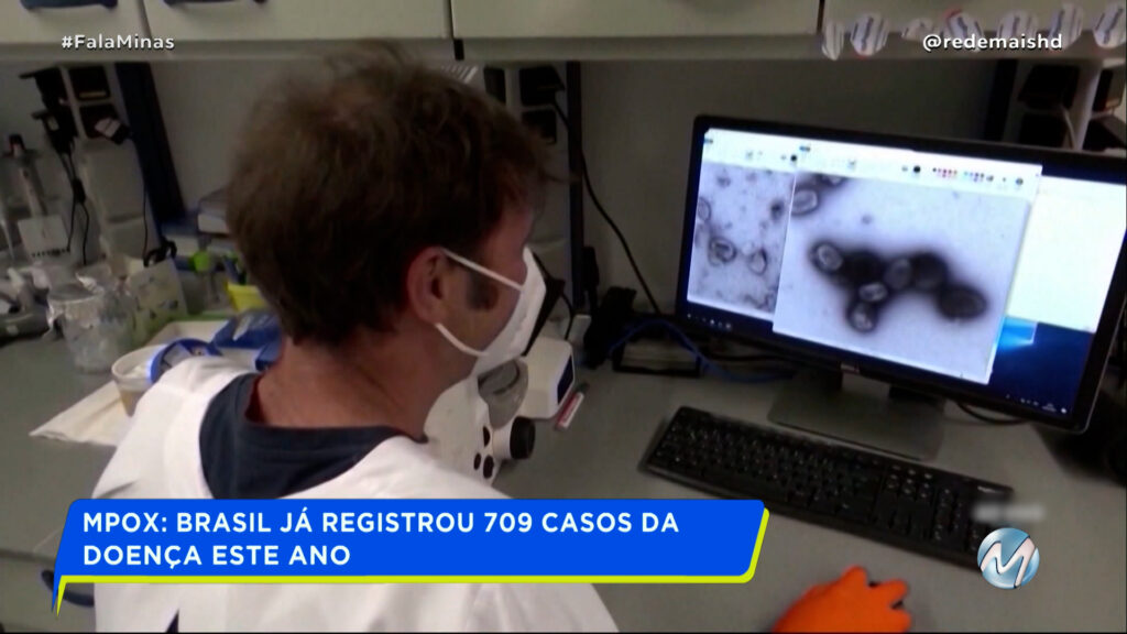 MPOX: CONHEÇA SINTOMAS E TIRE PRINCIPAIS DÚVIDAS SOBRE A DOENÇA