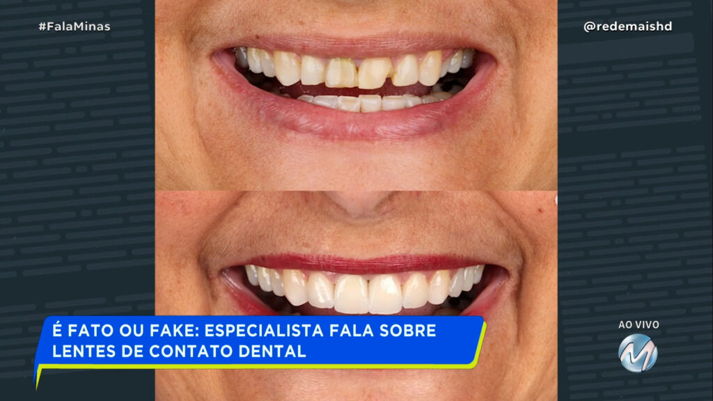 É FATO OU FAKE: ESPECIALISTA FALA SOBRE LENTES DE CONTATO DENTAL