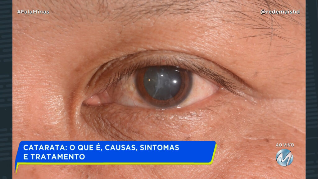 CATARATA: O QUE É, CAUSAS, SINTOMAS E TRATAMENTO