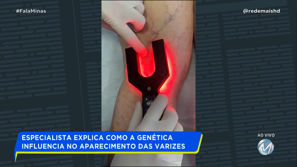 ESPECIALISTA EXPLICA COMO A GENÉTICA INFLUÊNCIA NO APARECIMENTO DAS VARIZES