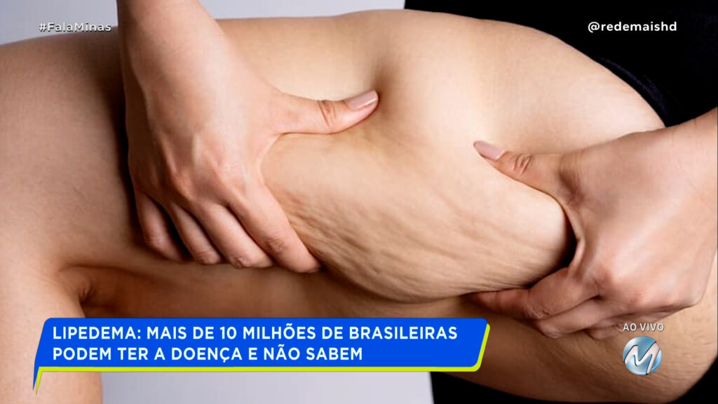 LIPEDEMA: MAIS DE 10 MILHÕES DE BRASILEIRAS PODEM TER A DOENÇA E NÃO SABEM