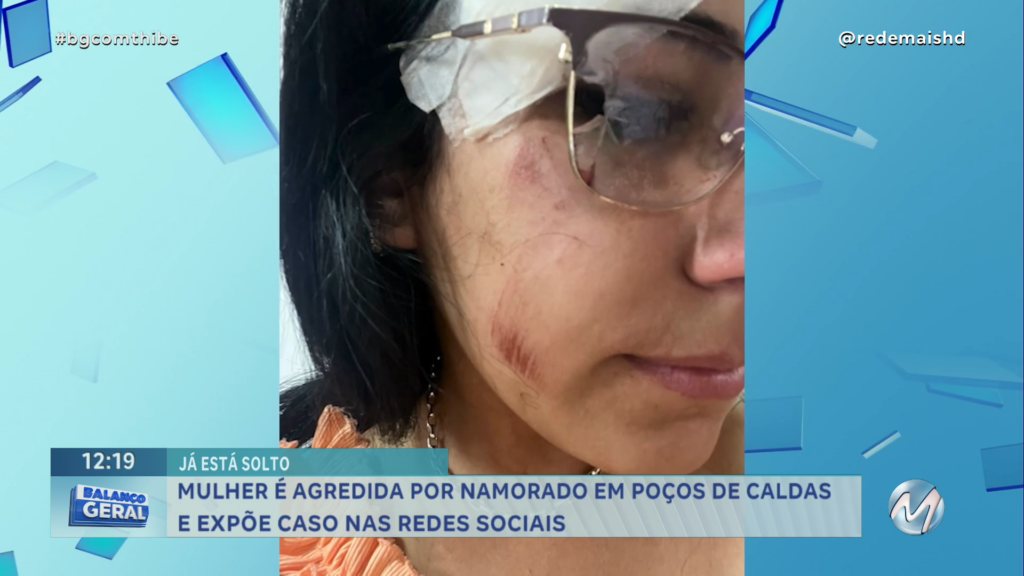 GRAVE: MULHER É AGREDIDA POR NAMORADO E EXPÕE CASO NAS REDES SOCIAIS